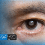 نصائح بعد عملية المياه البيضاء وزرع عدسة