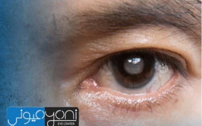 نصائح بعد عملية المياه البيضاء وزرع عدسة