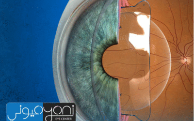 كم تكلفة زراعة عدسة العين