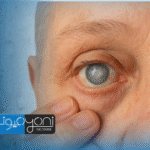 ما هي الآثار الجانبية لعملية المياه البيضاء