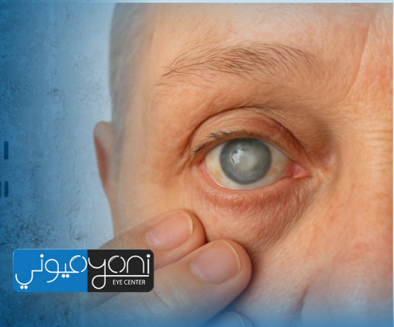 ما هي الآثار الجانبية لعملية المياه البيضاء