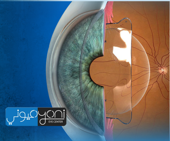 كم تكلفة زراعة عدسة العين