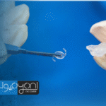 نصائح بعد عملية زراعة العدسات