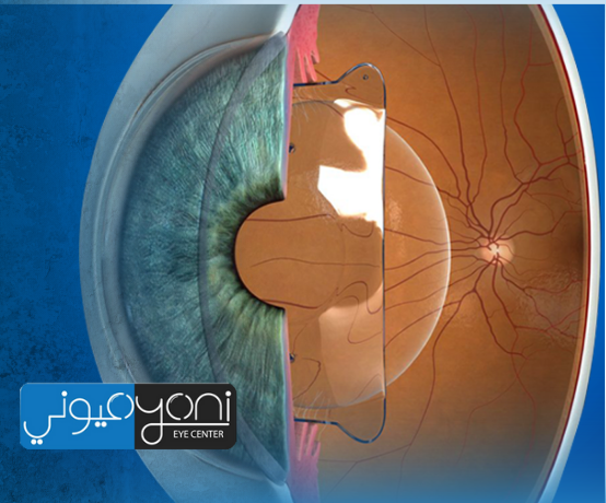 زراعة عدسات تصحيح النظر زراعة عدسات تصحيح النظر