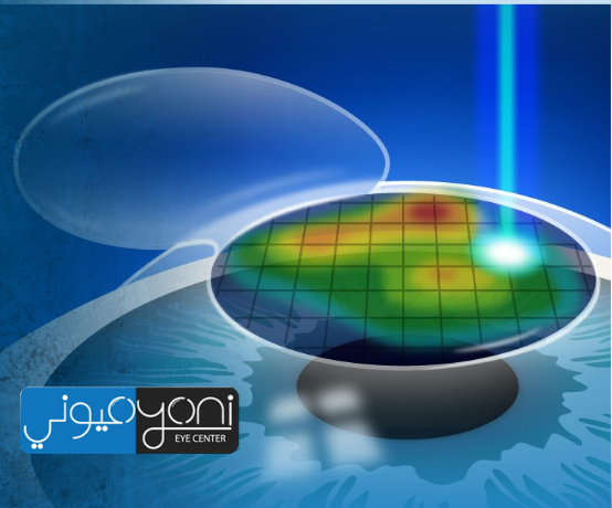 تكلفة عملية الفيمتو ليزك في مصر