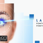 LASIK, Femto-LASIK, and Femto-Smile and the Difference Between Them