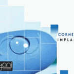 Corneal Ring Implantation