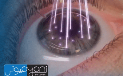 احسن دكتور ليزك في مصر — لماذا يختار كثيرون د. طارق عبد السميع في مركز عيوني؟