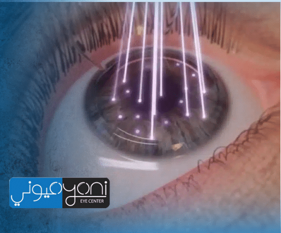 احسن دكتور ليزك في مصر