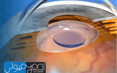 افضل انواع العدسات لعملية المياة البيضاء — دليل اختيار عملي يقودك إلى رؤية أوضح مع مركز عيوني