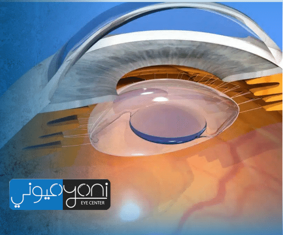 افضل انواع العدسات لعملية المياة البيضاء — دليل اختيار عملي يقودك إلى رؤية أوضح مع مركز عيوني
