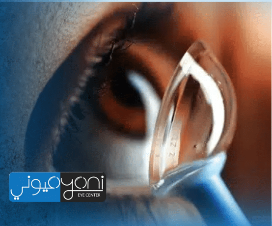 القرنية المخروطية بعد سن الأربعين: هل تتوقف؟ وكيف يتم التعامل معها طبيًا بدقة؟