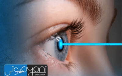 سعر عملية الفيمتو ليزك 2026: تعرف على التكلفة وأفضل عروض المراكز الطبية