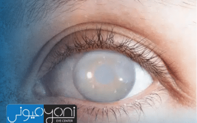 عمليات المياة البيضاء — الدليل الأوسع لاختيار المسار الجراحي والعدسة الأنسب مع مركز عيوني بإشراف الدكتور طارق عبد السميع