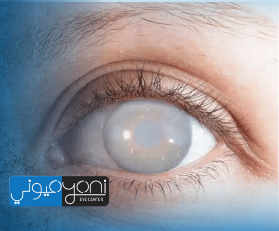 عمليات المياة البيضاء