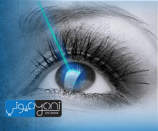عمليات ليزك العيون