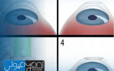 عملية الفيمتو ليزك: التقنية الأدق لعلاج ضعف النظر بدون ألم أو مضاعفات