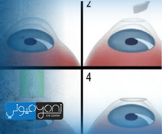 عملية الفيمتو ليزك: التقنية الأدق لعلاج ضعف النظر بدون ألم أو مضاعفات