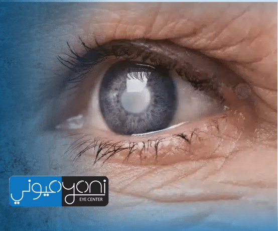 كم تكلفه عمليه المياه البيضاء في العين؟ دليل شامل يوضّح ما وراء الأرقام ويقودك للاختيار الأنسب