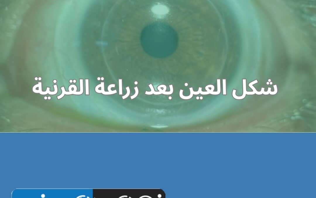 شكل العين بعد زراعة القرنية