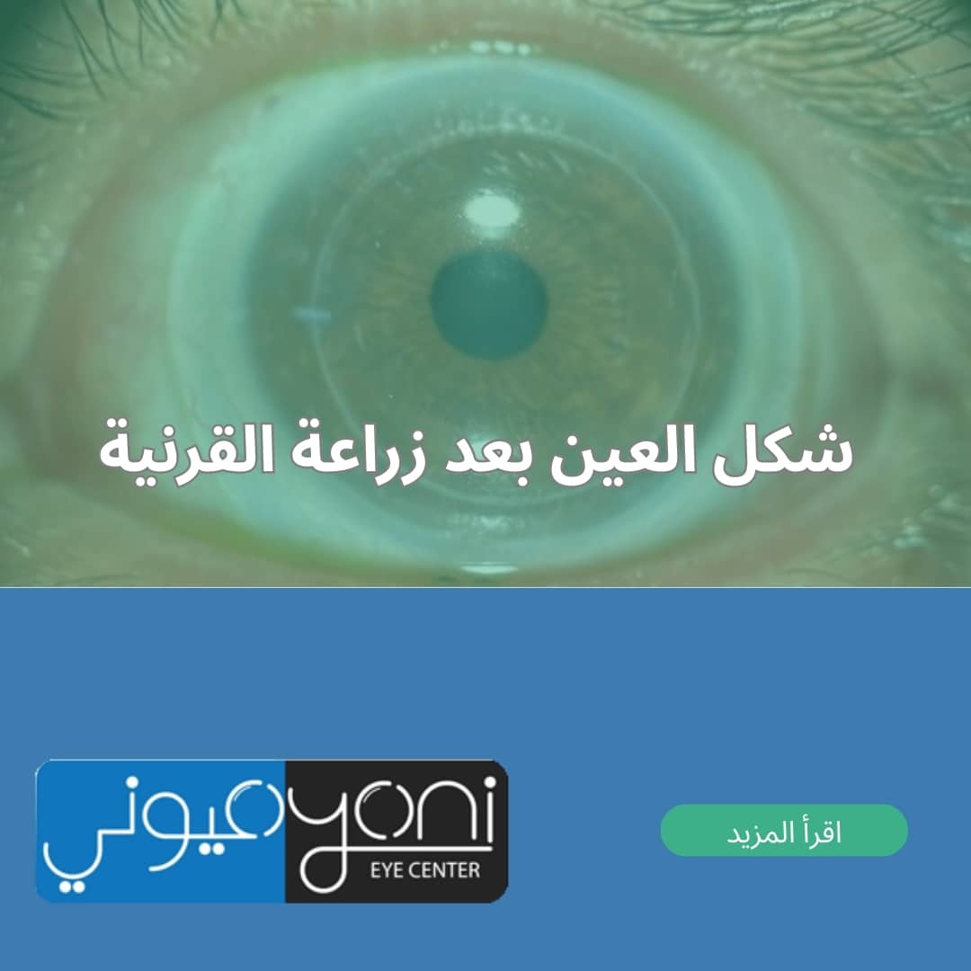 شكل العين بعد زراعة القرنية