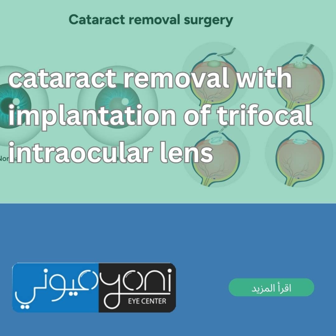 cataract removal with implantation of trifocal intraocular lens