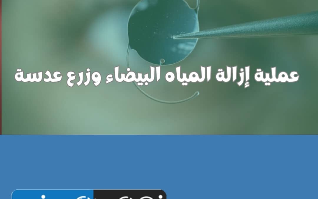عملية إزالة المياه البيضاء وزرع عدسة