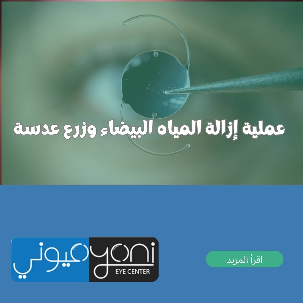 عملية إزالة المياه البيضاء وزرع عدسة