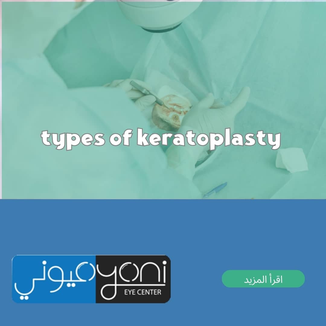 types of keratoplasty
