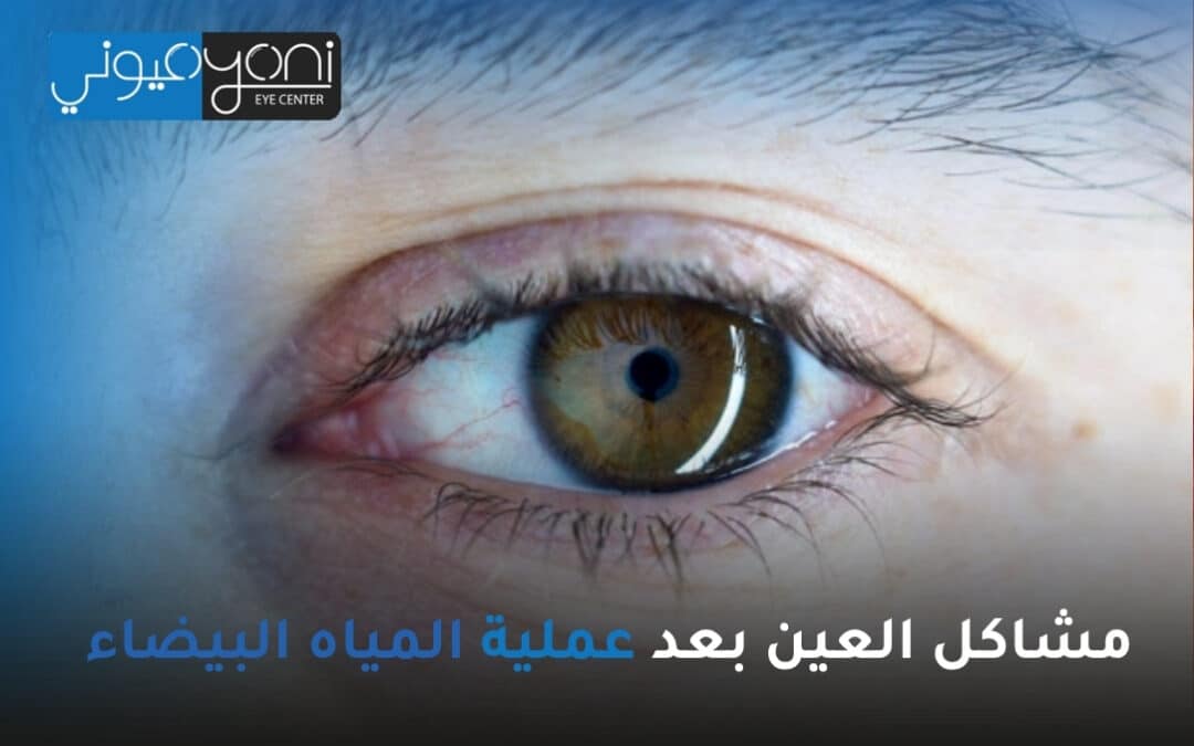 مشاكل العين بعد عملية المياه البيضاء