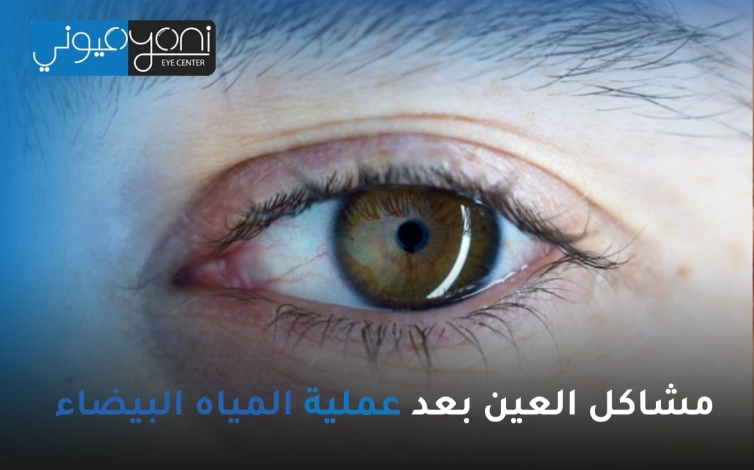 مشاكل العين بعد عملية المياه البيضاء