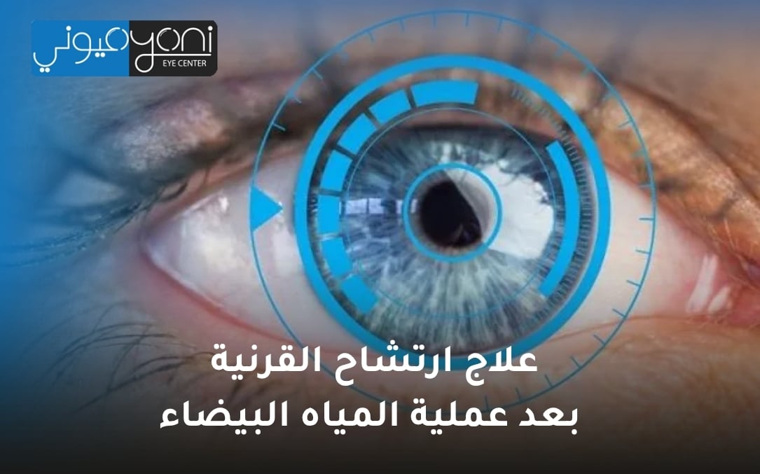 علاج ارتشاح القرنية بعد عملية المياه البيضاء