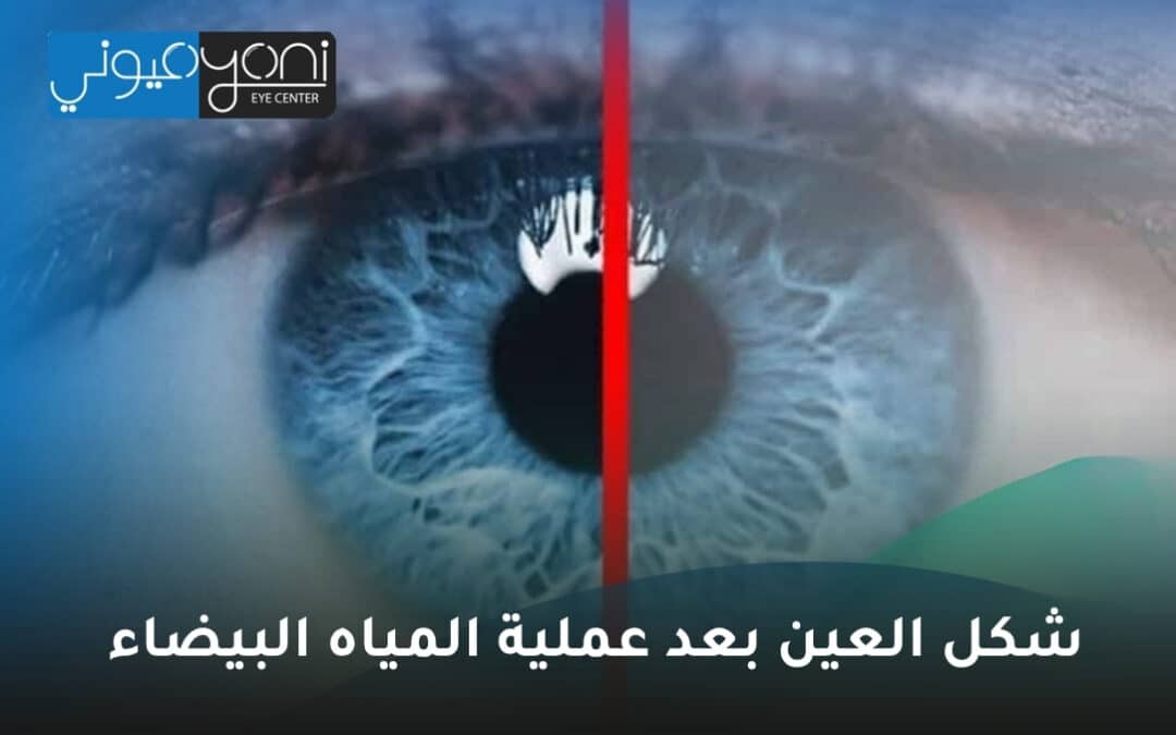 شكل العين بعد عملية المياه البيضاء