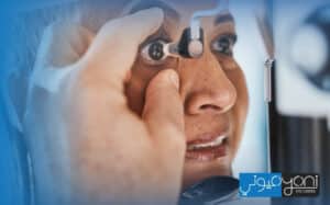 علاج ارتشاح القرنية بعد عملية المياه البيضاء