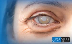 هل عملية الماء الأبيض سهلة