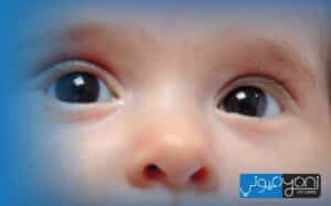 أسباب المياه البيضاء عند الأطفال
