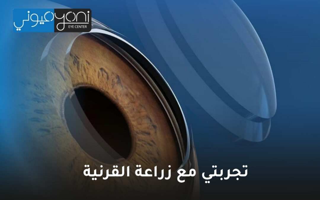 تجربتي مع زراعة القرنية: دليل شامل من مركز عيوني للعيون