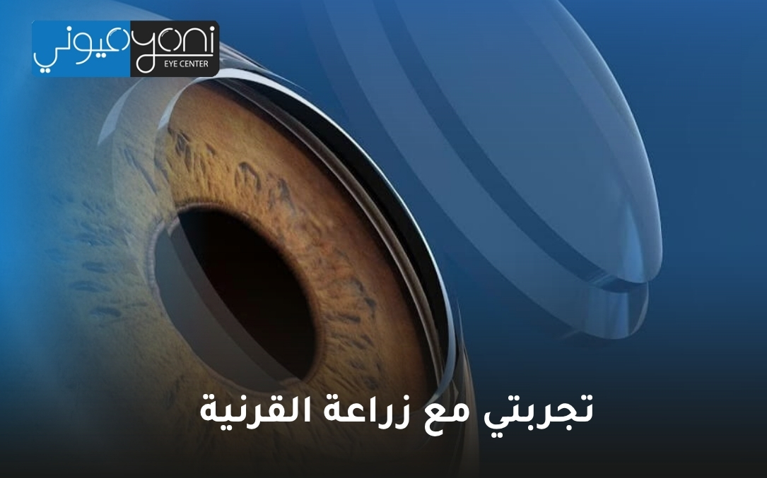 تجربتي مع زراعة القرنية