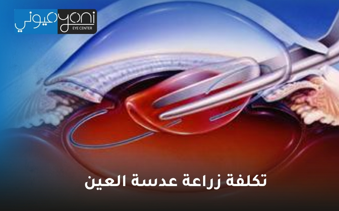 تكلفة زراعة عدسة العين