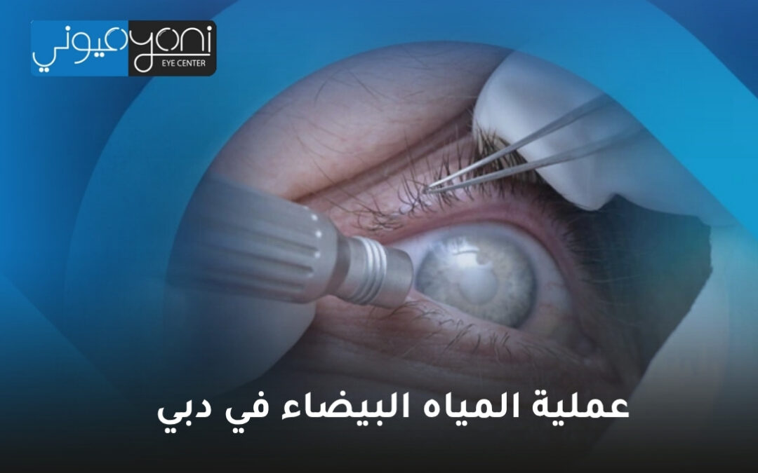 عملية المياه البيضاء في دبي: دليل شامل لاستعادة وضوح الرؤية
