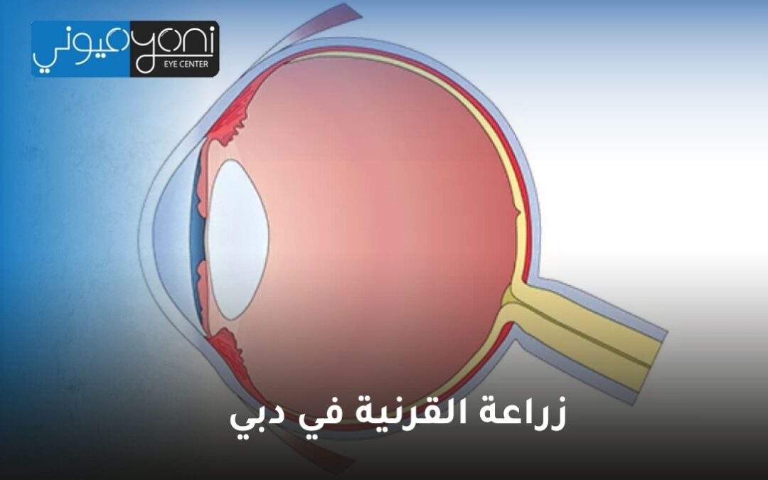 زراعة القرنية في دبي: دليل شامل لاستعادة وضوح الرؤية