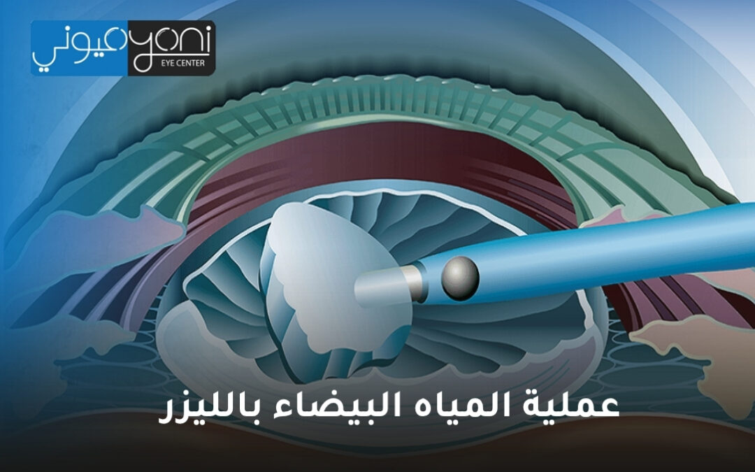عملية المياه البيضاء بالليزر: ثورة في استعادة وضوح الرؤية