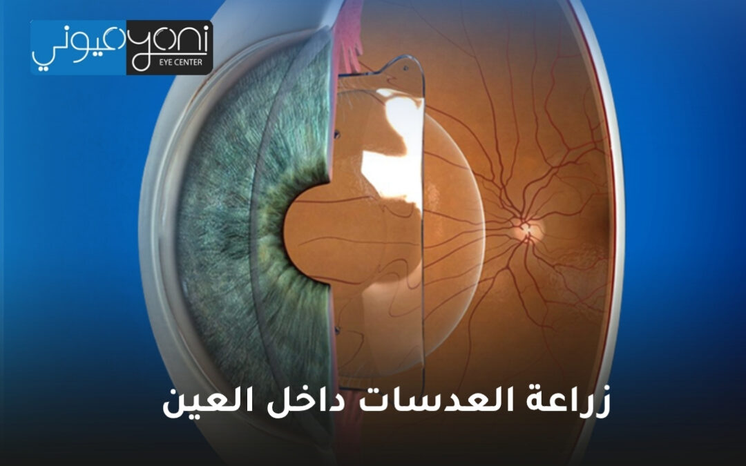 زراعة العدسات داخل العين: حل دائم لتحسين الرؤية