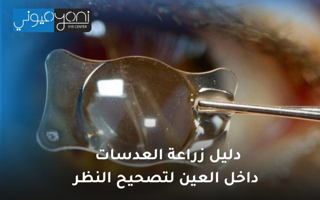 دليل زراعة العدسات داخل العين لتصحيح النظر