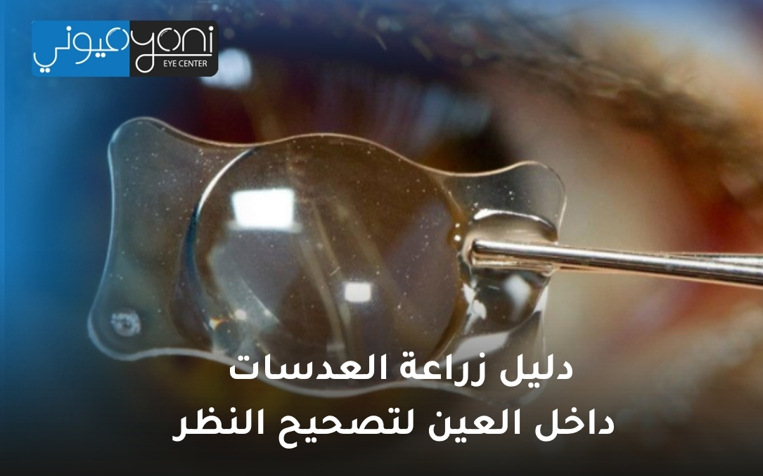 زراعة العدسات داخل العين