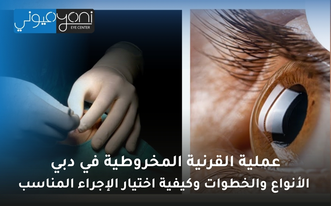 عملية القرنية المخروطية في دبي عملية القرنية المخروطية في دبي