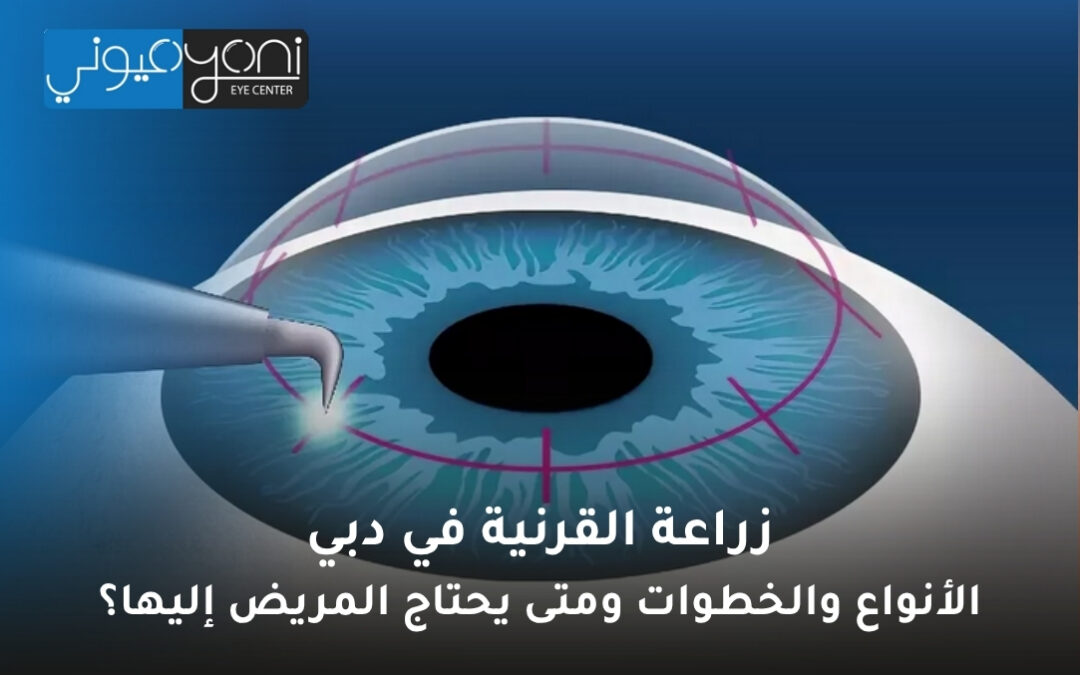 زراعة القرنية في دبي: الأنواع والخطوات ومتى يحتاج المريض إليها؟