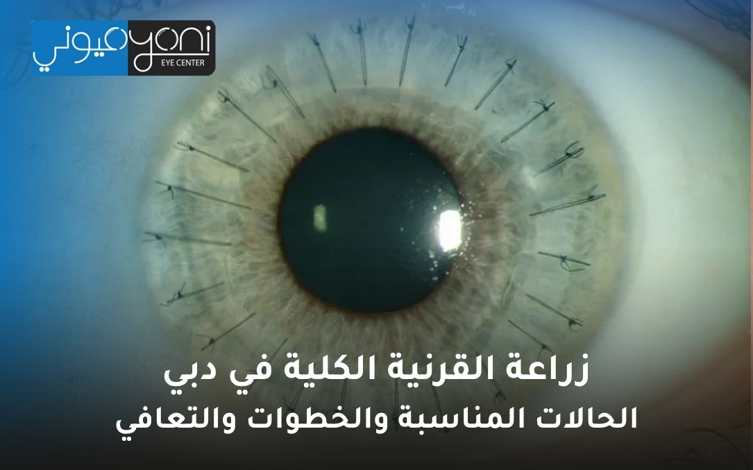زراعة القرنية الكلية في دبي زراعة القرنية الكلية في دبي