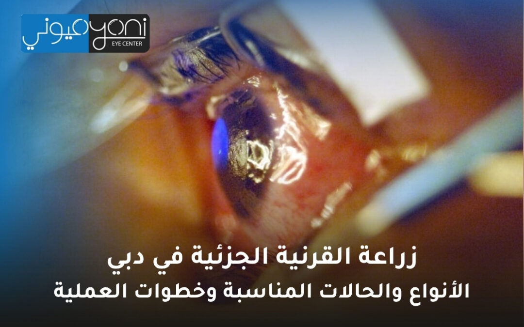 زراعة القرنية الجزئية في دبي: الأنواع والحالات المناسبة وخطوات العملية