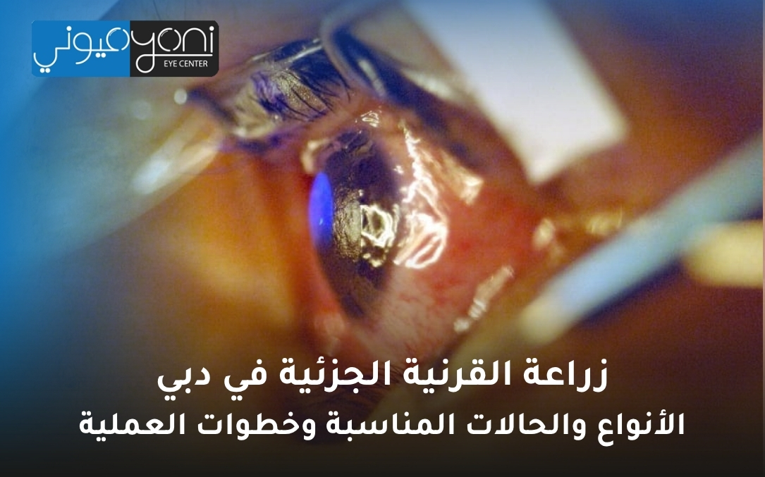 زراعة القرنية الجزئية في دبي زراعة القرنية الجزئية في دبي